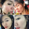 Serum Mụn Xương Rồng Không Bong, Không Sưng 5Ml - Mộc Thiên Hương - Ảnh 20