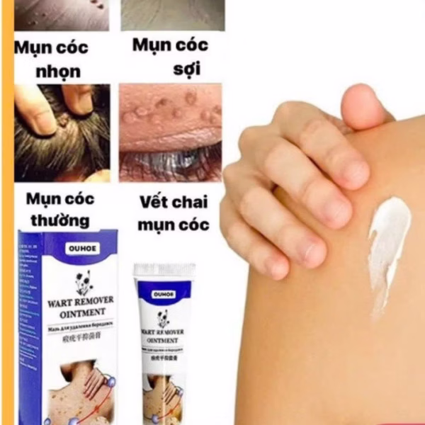 Kem Ouhoe Rụng Mụn Thịt Dư, Nốt Ruồi, Nốt Ve Chó, U Mềm Treo - Gdn