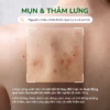 Combo 2 Chai Xịt Giảm Mụn Lưng Neoacnes - Ảnh 2