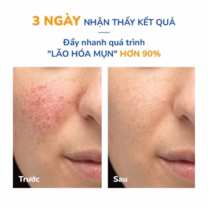Combo 2 Tuýp Gel Giảm Mụn Thâm Sẹo Neothera Acnes