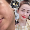 Combo Trị Mụn Acneskin Care - Soo Young - Ảnh 8