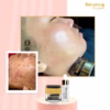 Combo Trị Mụn Acneskin Care - Soo Young - Ảnh 10