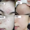 Gel Trị Mụn Xóa Thâm Do Mụn Megaduo - Gamma - Ảnh 2