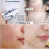 Kem Trị Mụn Differin Pháp - Galderma - Ảnh 2