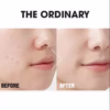 Serum Kiềm Dầu, Giảm Mụn, Se Khít Lỗ Chân Lông Niacinamide 10% + Zinc 1% - The Ordinary - Ảnh 3