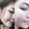 Kem Trị Mụn Hàn Quốc Pair Acne - Lion - Ảnh 2