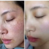Tuýp Kem Mờ Nám Tàn Nhang, Mụn Clobetamil 25G Kt1- Gdn - Ảnh 2