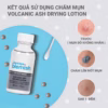 Lotion Chấm Mụn Tro Núi Lửa Giảm Mụn Nhanh Sau 1 Đêm Cho Mụn Đầu Trắng Volcanic Ash Drying Lotion 30Ml - Bye Bye Blemish - Ảnh 4