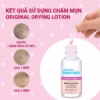 Lotion Chấm Mụn Giảm Mụn Nhanh Sau 1 Đêm Cho Mụn Đầu Trắng Original Drying Lotion 30Ml - Bye Bye Blemish - Ảnh 3