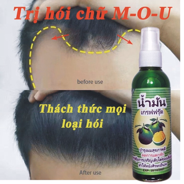 Xịt Mọc Tóc Bưởi Anh Thái Lan Kích Thích Mọc Tóc, Ngăn Ngừa Tóc Gãy Rụng Hiệu Quả 80Ml - Gdn - Ảnh 4
