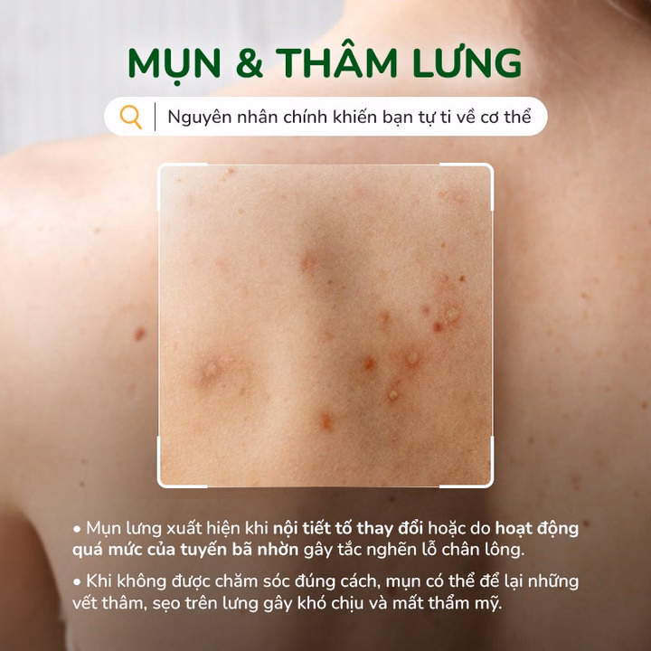 Xịt Mụn Lưng Neoacnes Hỗ Trợ Giảm Mụn, Mờ Thâm 100Ml - Ảnh 5