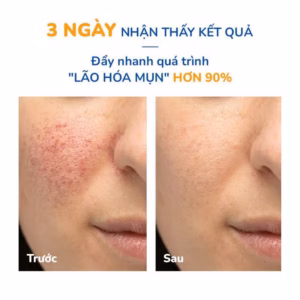 Combo 2 Tuýp Gel Giảm Mụn Thâm Sẹo Neothera Acnes
