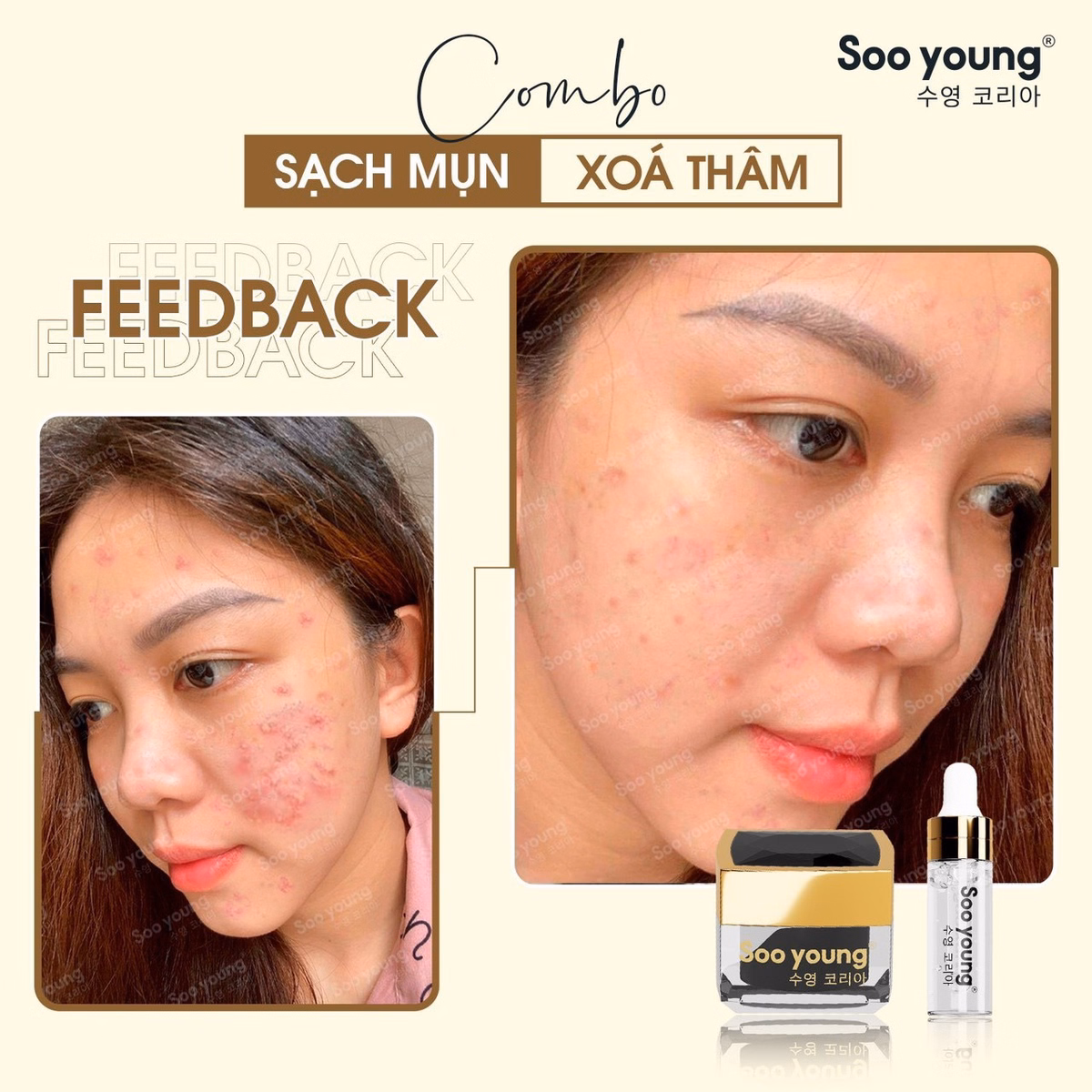 Combo Trị Mụn Acneskin Care - Soo Young - Ảnh 7