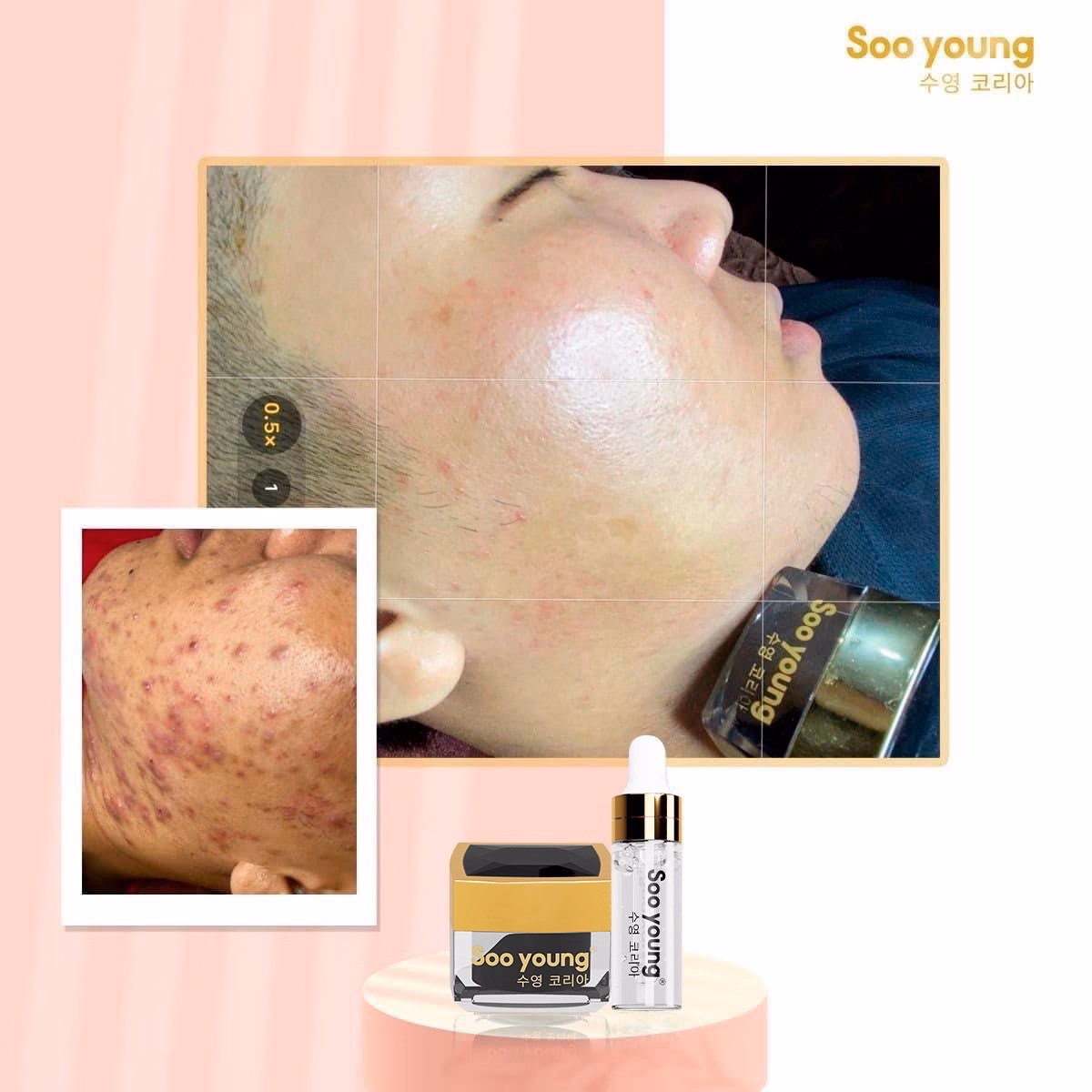 Combo Trị Mụn Acneskin Care - Soo Young - Ảnh 10