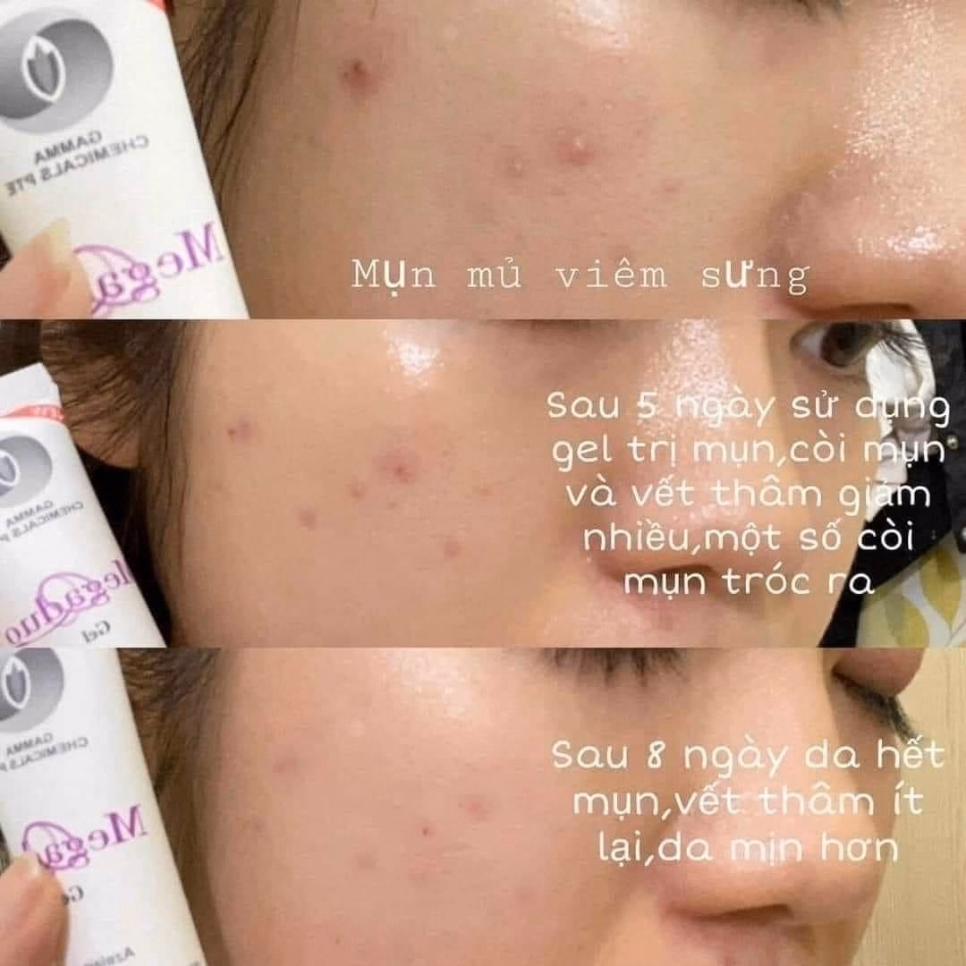 Gel Trị Mụn Xóa Thâm Do Mụn Megaduo - Gamma - Ảnh 5