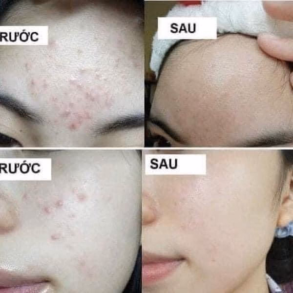 Gel Trị Mụn Xóa Thâm Do Mụn Megaduo - Gamma - Ảnh 2