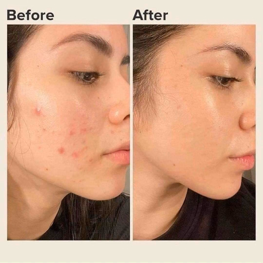 Gel Trị Mụn Ngừa Thâm Derma Forte - Gamma - Ảnh 5