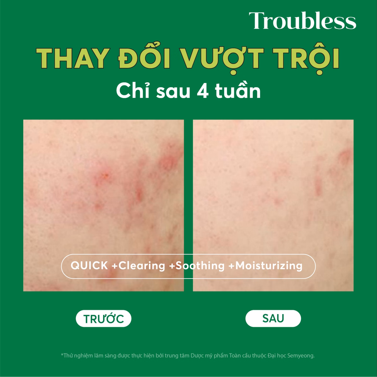 Nước Cân Bằng Troubless Làm Dịu Da Tẩy Tế Bào Chết, Sáng Da, Giảm Mụn 200Ml - Ảnh 4