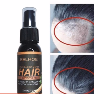 Xịt Mọc Tóc Nhân Sâm Giảm Rụng, Kích Mọc, Cải Thiện Hói Nấm Da Đầu 30Ml - Gdn