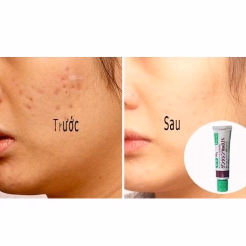 Kem Sẹo Gentacin Làm Mờ Sẹo Lồi, Sẹo Rỗ ,Sẹo Thâm Nhật Bản 10G - Be Yourself - Ảnh 5